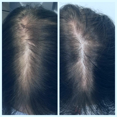 PRP Hair Treatment & Hair Loss - South Florida Dermatology